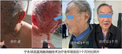 宁永球适温消融技术:中西医融合创新之路与医学革命的全球实践