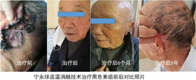 宁永球适温消融技术:中西医融合创新之路与医学革命的全球实践
