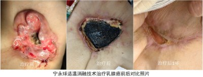 宁永球适温消融技术:中西医融合创新之路与医学革命的全球实践