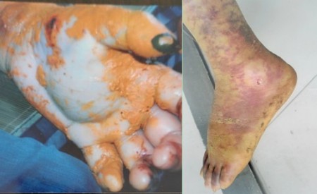 聚焦两会特别报道：蛇伤救治“守护者”汪炳炎——用医者仁心诠释基层担当